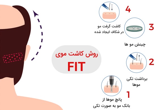 مراح کاشت مو به روش FIT