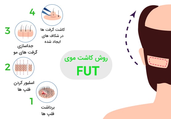 کاشت موی طبیعی به روش FUT​